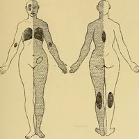 Picture 22 of 85 from Leçons cliniques sur l'hystérie et l'hypnotisme : faites à l'Hôpital Saint-André de Bordeaux (1891), leaf 256