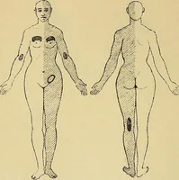 An illustration from Leçons cliniques sur l'hystérie et l'hypnotisme : faites à l'Hôpital Saint-André de Bordeaux (1891)