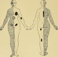 Picture 24 of 85 from Leçons cliniques sur l'hystérie et l'hypnotisme : faites à l'Hôpital Saint-André de Bordeaux (1891), leaf 259
