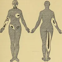 Picture 25 of 85 from Leçons cliniques sur l'hystérie et l'hypnotisme : faites à l'Hôpital Saint-André de Bordeaux (1891), leaf 260