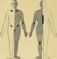 An illustration from Leçons cliniques sur l'hystérie et l'hypnotisme : faites à l'Hôpital Saint-André de Bordeaux (1891)