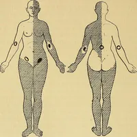 An illustration from Leçons cliniques sur l'hystérie et l'hypnotisme : faites à l'Hôpital Saint-André de Bordeaux (1891)