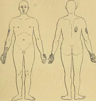 An illustration from Leçons cliniques sur l'hystérie et l'hypnotisme : faites à l'Hôpital Saint-André de Bordeaux (1891)