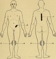An illustration from Leçons cliniques sur l'hystérie et l'hypnotisme : faites à l'Hôpital Saint-André de Bordeaux (1891)