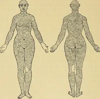 An illustration from Leçons cliniques sur l'hystérie et l'hypnotisme : faites à l'Hôpital Saint-André de Bordeaux (1891)