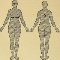 Picture 36 of 85 from Leçons cliniques sur l'hystérie et l'hypnotisme : faites à l'Hôpital Saint-André de Bordeaux (1891), leaf 327
