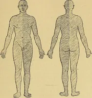 An illustration from Leçons cliniques sur l'hystérie et l'hypnotisme : faites à l'Hôpital Saint-André de Bordeaux (1891)