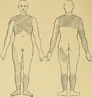 An illustration from Leçons cliniques sur l'hystérie et l'hypnotisme : faites à l'Hôpital Saint-André de Bordeaux (1891)