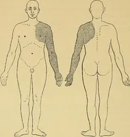 Picture 50 of 85 from Leçons cliniques sur l'hystérie et l'hypnotisme : faites à l'Hôpital Saint-André de Bordeaux (1891), leaf 437