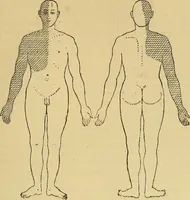 Picture 52 of 85 from Leçons cliniques sur l'hystérie et l'hypnotisme : faites à l'Hôpital Saint-André de Bordeaux (1891), leaf 440