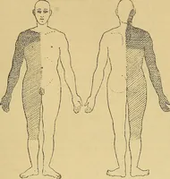 An illustration from Leçons cliniques sur l'hystérie et l'hypnotisme : faites à l'Hôpital Saint-André de Bordeaux (1891)