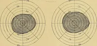 Picture 55 of 85 from Leçons cliniques sur l'hystérie et l'hypnotisme : faites à l'Hôpital Saint-André de Bordeaux (1891), leaf 442