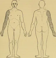 Picture 56 of 85 from Leçons cliniques sur l'hystérie et l'hypnotisme : faites à l'Hôpital Saint-André de Bordeaux (1891), leaf 444