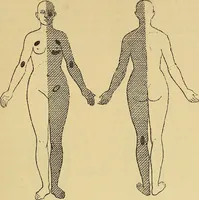 Picture 63 of 85 from Leçons cliniques sur l'hystérie et l'hypnotisme : faites à l'Hôpital Saint-André de Bordeaux (1891), leaf 468