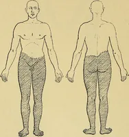 An illustration from Leçons cliniques sur l'hystérie et l'hypnotisme : faites à l'Hôpital Saint-André de Bordeaux (1891)