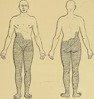 An illustration from Leçons cliniques sur l'hystérie et l'hypnotisme : faites à l'Hôpital Saint-André de Bordeaux (1891)