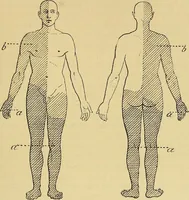 An illustration from Leçons cliniques sur l'hystérie et l'hypnotisme : faites à l'Hôpital Saint-André de Bordeaux (1891)