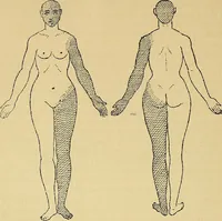 An illustration from Leçons cliniques sur l'hystérie et l'hypnotisme : faites à l'Hôpital Saint-André de Bordeaux (1891)