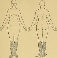 An illustration from Leçons cliniques sur l'hystérie et l'hypnotisme : faites à l'Hôpital Saint-André de Bordeaux (1891)