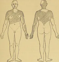 An illustration from Leçons cliniques sur l'hystérie et l'hypnotisme : faites à l'Hôpital Saint-André de Bordeaux (1891)