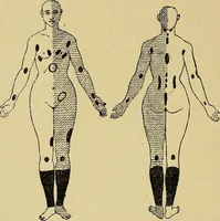 Picture 16 of 83 from Leçons cliniques sur l'hystérie et l'hypnotisme : faites à l'Hôpital Saint-André de Bordeaux (1891), leaf 111