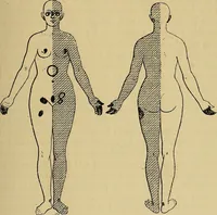 Picture 17 of 83 from Leçons cliniques sur l'hystérie et l'hypnotisme : faites à l'Hôpital Saint-André de Bordeaux (1891), leaf 112