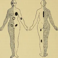 Picture 18 of 83 from Leçons cliniques sur l'hystérie et l'hypnotisme : faites à l'Hôpital Saint-André de Bordeaux (1891), leaf 115