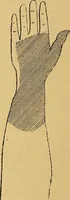An illustration from Leçons cliniques sur l'hystérie et l'hypnotisme : faites à l'Hôpital Saint-André de Bordeaux (1891)