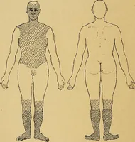 An illustration from Leçons cliniques sur l'hystérie et l'hypnotisme : faites à l'Hôpital Saint-André de Bordeaux (1891)