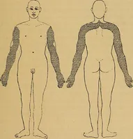 An illustration from Leçons cliniques sur l'hystérie et l'hypnotisme : faites à l'Hôpital Saint-André de Bordeaux (1891)