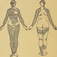 An illustration from Leçons cliniques sur l'hystérie et l'hypnotisme : faites à l'Hôpital Saint-André de Bordeaux (1891)
