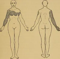 Picture 7 of 83 from Leçons cliniques sur l'hystérie et l'hypnotisme : faites à l'Hôpital Saint-André de Bordeaux (1891), leaf 24