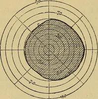 Picture 36 of 83 from Leçons cliniques sur l'hystérie et l'hypnotisme : faites à l'Hôpital Saint-André de Bordeaux (1891), leaf 332