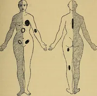 Picture 37 of 83 from Leçons cliniques sur l'hystérie et l'hypnotisme : faites à l'Hôpital Saint-André de Bordeaux (1891), leaf 334