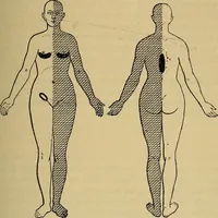 Picture 44 of 83 from Leçons cliniques sur l'hystérie et l'hypnotisme : faites à l'Hôpital Saint-André de Bordeaux (1891), leaf 364