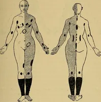 An illustration from Leçons cliniques sur l'hystérie et l'hypnotisme : faites à l'Hôpital Saint-André de Bordeaux (1891)