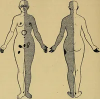 An illustration from Leçons cliniques sur l'hystérie et l'hypnotisme : faites à l'Hôpital Saint-André de Bordeaux (1891)