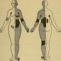 Picture 57 of 83 from Leçons cliniques sur l'hystérie et l'hypnotisme : faites à l'Hôpital Saint-André de Bordeaux (1891), leaf 434