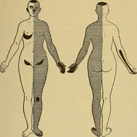 Picture 58 of 83 from Leçons cliniques sur l'hystérie et l'hypnotisme : faites à l'Hôpital Saint-André de Bordeaux (1891), leaf 436