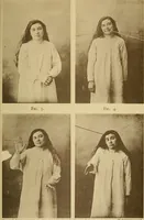 Picture 73 of 83 from Leçons cliniques sur l'hystérie et l'hypnotisme : faites à l'Hôpital Saint-André de Bordeaux (1891), leaf 534