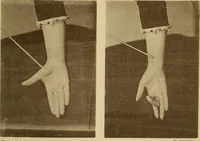 Picture 81 of 83 from Leçons cliniques sur l'hystérie et l'hypnotisme : faites à l'Hôpital Saint-André de Bordeaux (1891), leaf 540