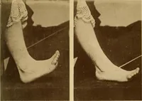 Picture 82 of 83 from Leçons cliniques sur l'hystérie et l'hypnotisme : faites à l'Hôpital Saint-André de Bordeaux (1891), leaf 542