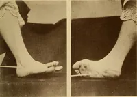 Picture 83 of 83 from Leçons cliniques sur l'hystérie et l'hypnotisme : faites à l'Hôpital Saint-André de Bordeaux (1891), leaf 542