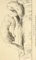 An illustration from Les maladies épidémiques de l'esprit; sorcellerie, magnétisme, morphinisme, délire des grandeurs (1887)