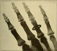 An illustration from Les rayons X et la photographie a travers les corps opaques (1896)