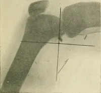 An illustration from Localization by X-rays and stereoscopy (1916)