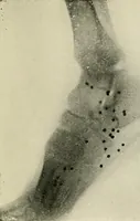An illustration from Localization by X-rays and stereoscopy (1916)
