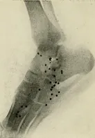 An illustration from Localization by X-rays and stereoscopy (1916)