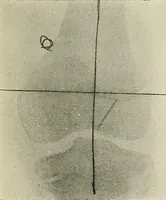 An illustration from Localization by X-rays and stereoscopy (1916)