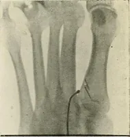 An illustration from Localization by X-rays and stereoscopy (1916)